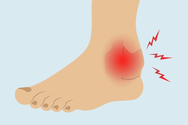 Illustration of a foot with red inflammation and pain radiating from the ankle.