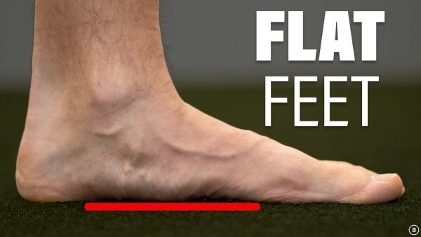 : "Side profile of a left foot with a collapsed arch, marked by a red line on a green turf background, labeled with 'FLAT FEET' in large white text