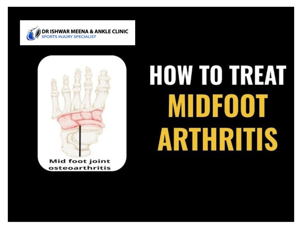 Diagram of a foot highlighting midfoot arthritis with a title on the right: "How to treat midfoot arthritis." Above the diagram, the text reads: "Dr. Ishwar Meena & Ankle Clinic, Sports Injury Specialist