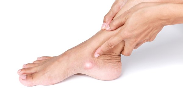 A person pointing to a swelling or lump near their ankle, possibly indicating pain or infection