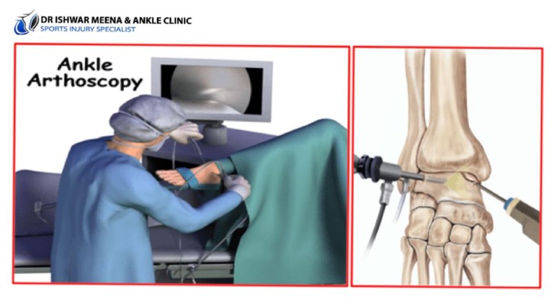 Ankle Arthroscopy: A surgeon performs a minimally invasive ankle surgery using an arthroscope, while a medical illustration shows the insertion of surgical tools into the ankle joint.