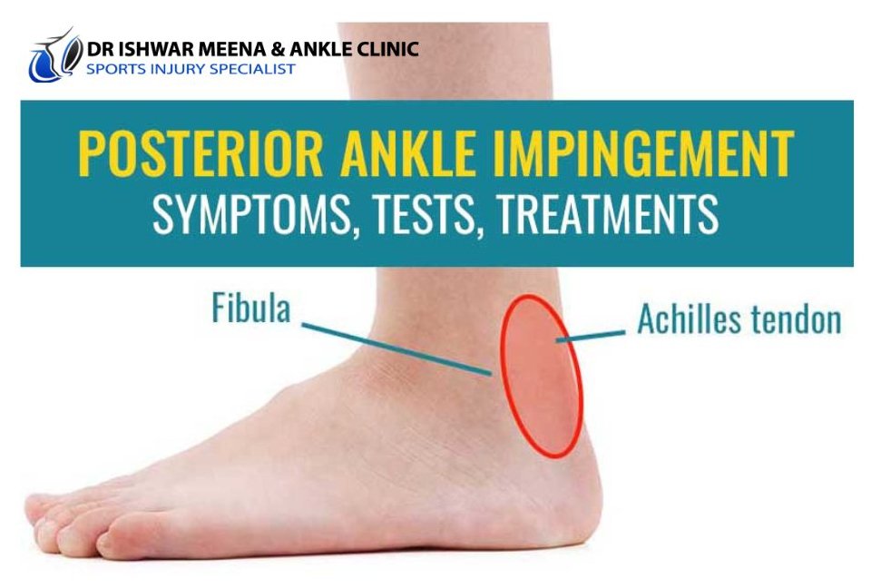 Diagram showing posterior ankle impingement area on a foot, highlighting the Achilles tendon and fibula.