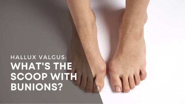 Two feet side by side, the left foot with a bunion on the big toe, against a light grey background with a text overlay discussing hallux valgus