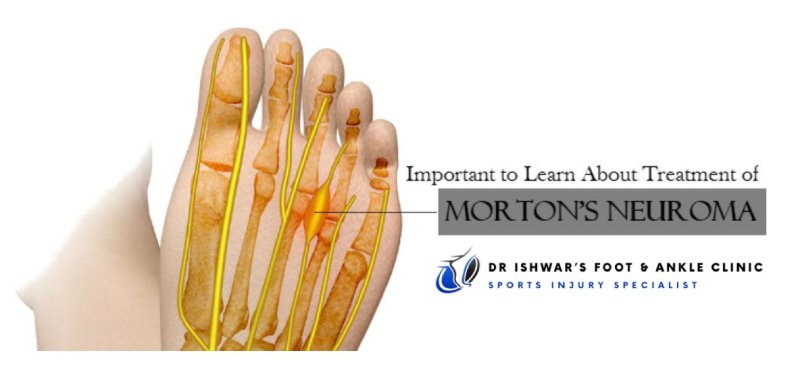 Diagram of a foot with nerves highlighted, focusing on Morton's Neuroma, with text about treatment and Dr. Ishwar's Foot & Ankle Clinic logo