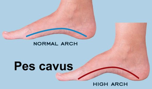 Side view comparison of normal arch versus high arch (Pes Cavus) in feet, showing the difference in curvature.