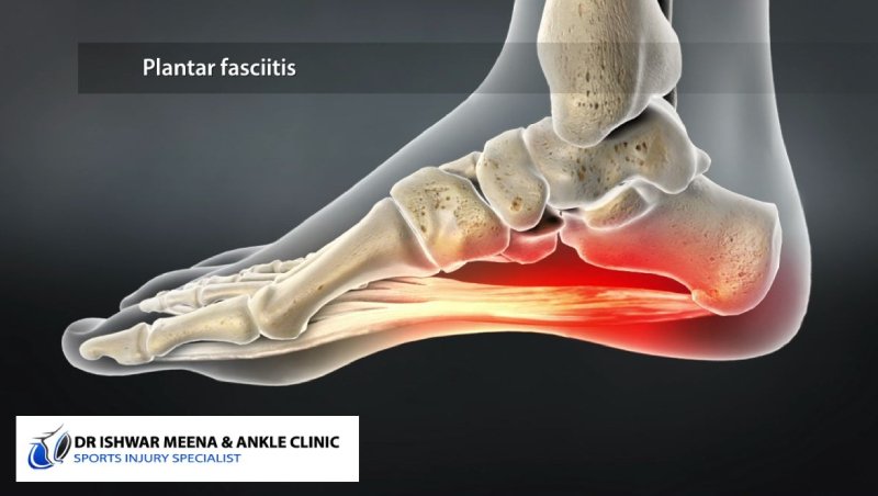 Illustration of a foot with plantar fasciitis, showing inflammation in the heel and arch area of the plantar fascia. Dr. Ishwar Meena & Ankle Clinic logo is shown