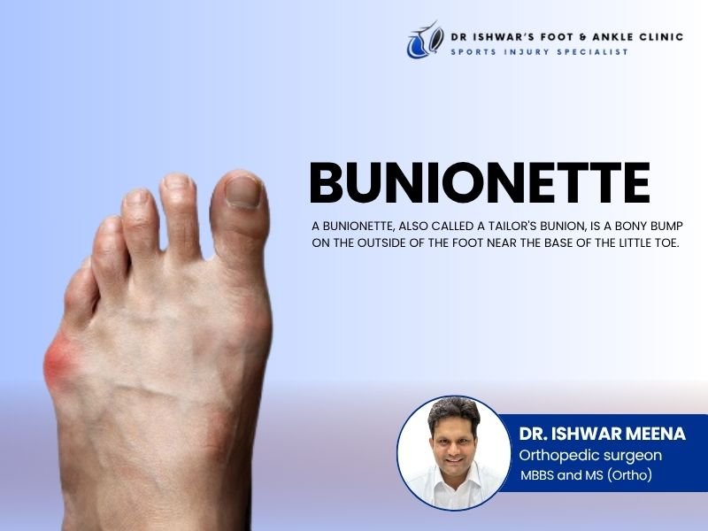 Close-up of foot with bunionette (Tailor’s Bunion) on the little toe side, with text overlay explaining the condition and featuring Dr. Ishwar Meena, orthopedic surgeon in Jaipur.